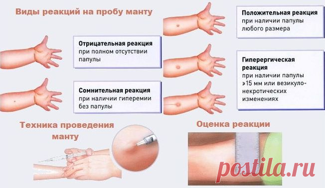 Какая должна быть реакция манту: размеры нормы у детей, можно ли мочить, противопоказания
