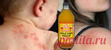 Вот как использовать яблочный уксус для лечения экземы, это невероятно эффективный метод! — Полезные советы