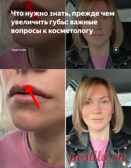 Что нужно знать, прежде чем увеличить губы: важные вопросы к косметологу | Леди Лайк | Яндекс Дзен