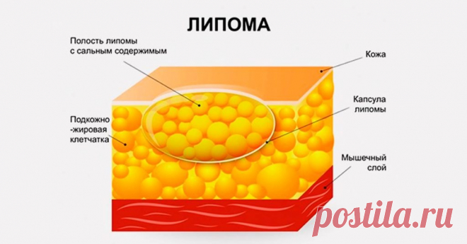 Вот, как избавиться от липомы быстро и легко! 4 народных рецепта со 100% эффективностью!