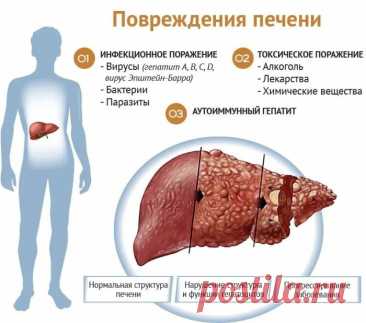 Симптомы болезни печени: