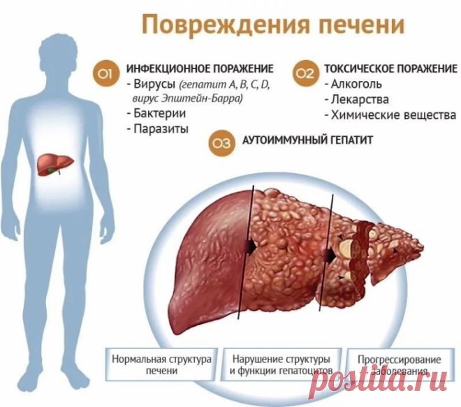 Симптомы болезни печени: