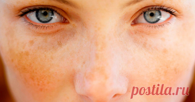 Домашний лосьон, отбеливающий веснушки и темные пятна - Образованная Сова Этот домашний лосьон сделан из лимона (или натурального яблочного уксуса) и листьев петрушки. Он поможет Вам отбелить кожу, убрать веснушки и темные пятна на лице. После его использования ваша кожа будет иметь ровный цвет и ухоженный вид. Петрушка богата минералами и витаминами. Сок этого растения содержит эфирные масла, богатые содержанием марганца и калия. Она может быть использован в качестве лека...