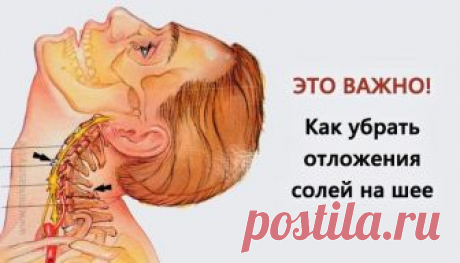 Избавляемся от отложения солей на шее / Все для женщины