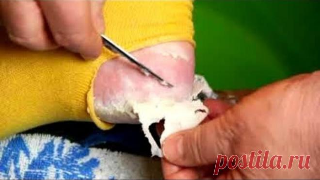 ШОК! КАК СДЕЛАТЬ ПЯТКИ КАК У МЛАДЕНЦА!!!