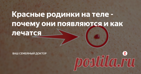 Красные родинки на теле - почему они появляются и как лечатся На теле практически каждого человека располагаются родинки различных размеров и форм. Они могут быть врожденными, а также появляться в течение жизни.
По большей части родинки не представляют опасности для здоровья человека, однако в определенных случаях возникновение таких образований может нести отрицательное воздействие на организм. В связи с этим крайне желательно своевременно заняться устранен