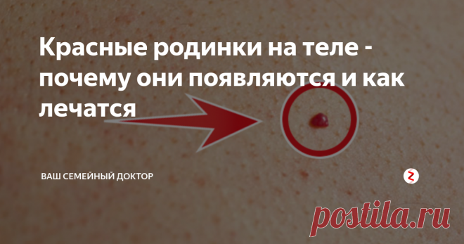 Красные родинки на теле - почему они появляются и как лечатся На теле практически каждого человека располагаются родинки различных размеров и форм. Они могут быть врожденными, а также появляться в течение жизни.
По большей части родинки не представляют опасности для здоровья человека, однако в определенных случаях возникновение таких образований может нести отрицательное воздействие на организм. В связи с этим крайне желательно своевременно заняться устранен