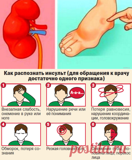 За месяц до инсульта, тело будет посылать Вам эти сигналы. Не игнорируйте их