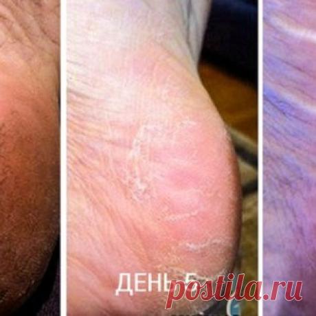 Первоклассное средство против трещин на пятках: смешай 2 ингредиента и забудь о проблеме!
