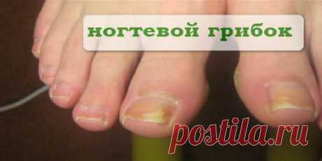 Как от грибка-ногтоеда легко избавляются! Вот это способ, надо же как просто! Существует очень необычный, а главное действенный способ по устранению грибка-ногтоеда.   Для этого нужно взять 10 швейных иголок, но ни в коем случае не машинных, поломать их на несколько частей