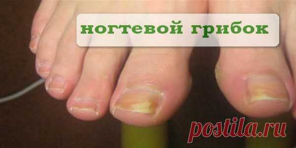 Как от грибка-ногтоеда легко избавляются! Вот это способ, надо же как просто! Существует очень необычный, а главное действенный способ по устранению грибка-ногтоеда.   Для этого нужно взять 10 швейных иголок, но ни в коем случае не машинных, поломать их на несколько частей