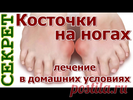 Косточки на ногах: эти 4 натуральных средства эффективно выведут соли и быстро избавят от боли! — Полезные советы