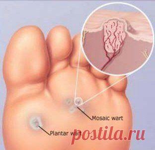 Действенный рецепт от бородавок /
1. Тщательно моем и сушим места обработки.
2. Протираем их спиртосодержащим раствором.
3. Бородавки покрываем сверху тонкой пленкой клея БФ-6 (медицинский) или даже БФ-2 (технический) так, чтобы данный участок «не дышал».
4. Процедуру проводим 3-4 раза в сутки по мере возможности (утро, обед, перед сном), так как препараты можно иметь при себе в кармане.
Через 5-6 дней они выпадут из своего «гнезда».