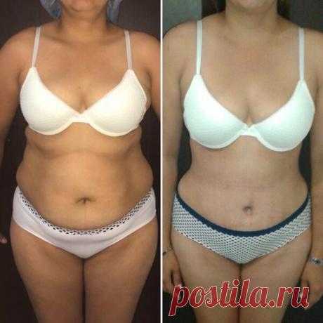 Мой опыт применения домашнего средства: дряблая кожа и жир на животе ушли за 15 дней
1. Моя предыстория.

С детства я была пухленькой. Став студенткой я серьезно озадачилась как же мне можно похудеть.

Чего я только не делала. Применяла водную диету и не ела по 3 дня, бегала по утрам, ходила в