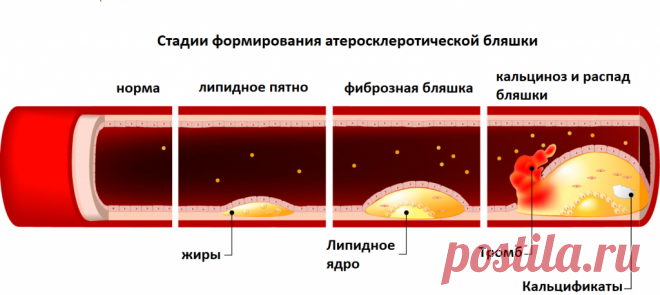 Атеросклероз - причины появления, симптомы заболевания, диагностика и способы лечения