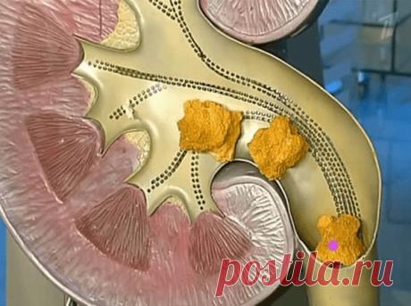Как избавиться от песка и маленьких камней в почках