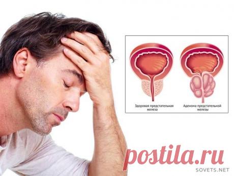 АДЕНОМА ПРЕДСТАТЕЛЬНОЙ ЖЕЛЕЗЫ.