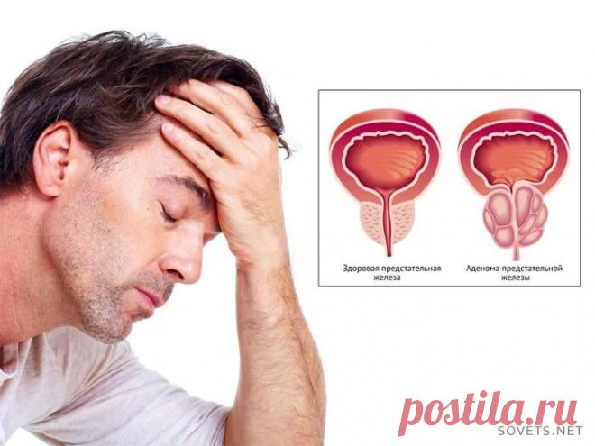АДЕНОМА ПРЕДСТАТЕЛЬНОЙ ЖЕЛЕЗЫ.