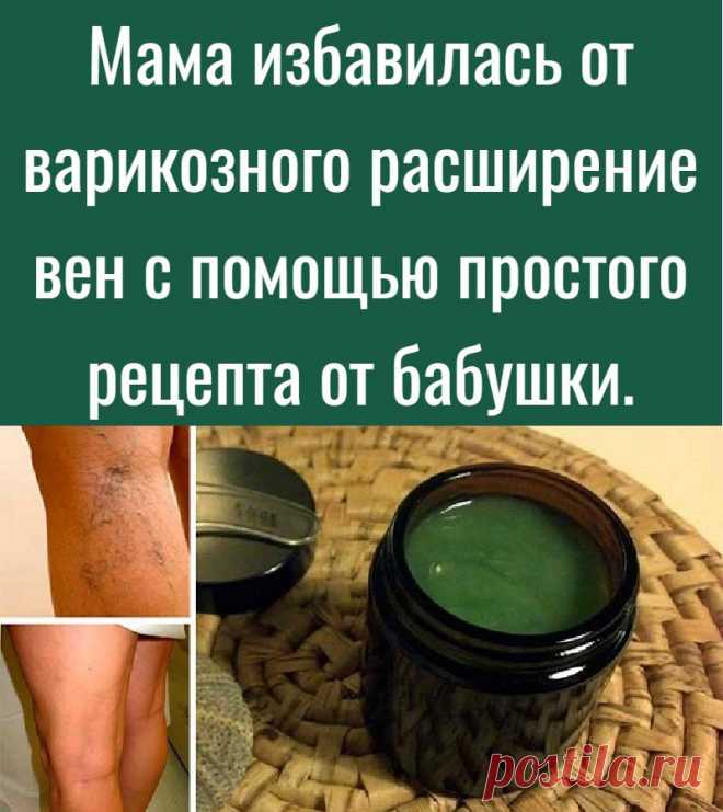 Мама избавилась от варикозного расширение вен с помощью простого рецепта от бабушки.