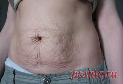 Дряблость кожи: тела, на шее, на лице, причины, как бороться с дряблостью кожи, способы устранения