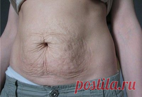 Дряблость кожи: тела, на шее, на лице, причины, как бороться с дряблостью кожи, способы устранения