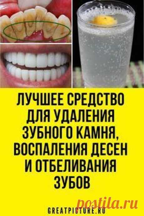 Лучшее средство для удаления зубного камня,и отбеливания зубов! Следим за зубами