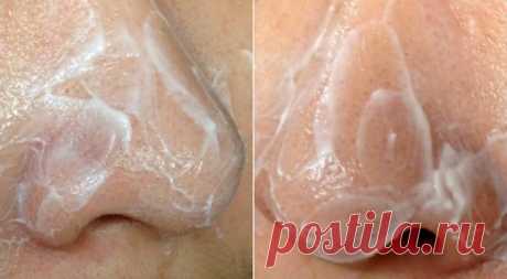 Is Vaseline can remove blackheads, are you wonder???