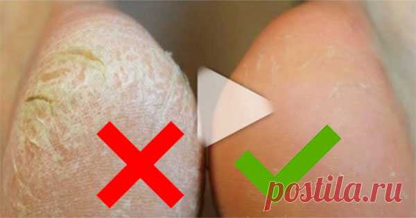 Сделайте ваши пяточки гладкими: эффективный домашний способ. Гарантия результата! Для тех, кому не терпится раз и навсегда покончить с огрубевшей кожей, есть поистине уникальный во всех отношениях способ...