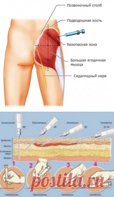 Как делать инъекции самостоятельно