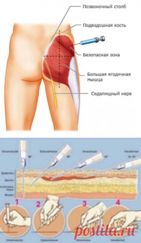 Как делать инъекции самостоятельно