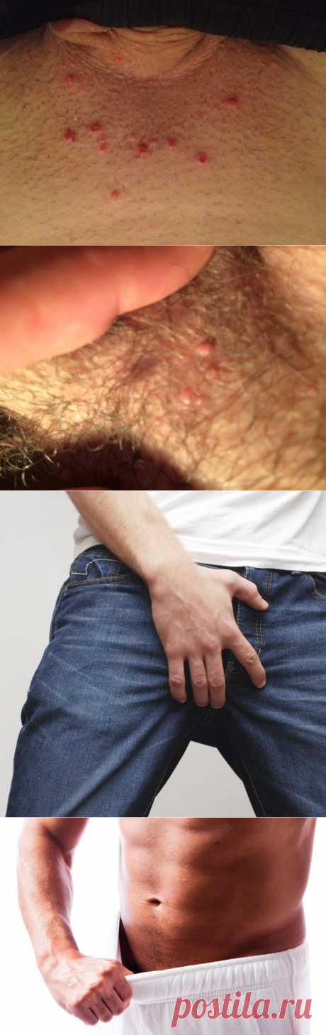 Прыщи на члене — почему появляются? [#лечение] Как избавится?
