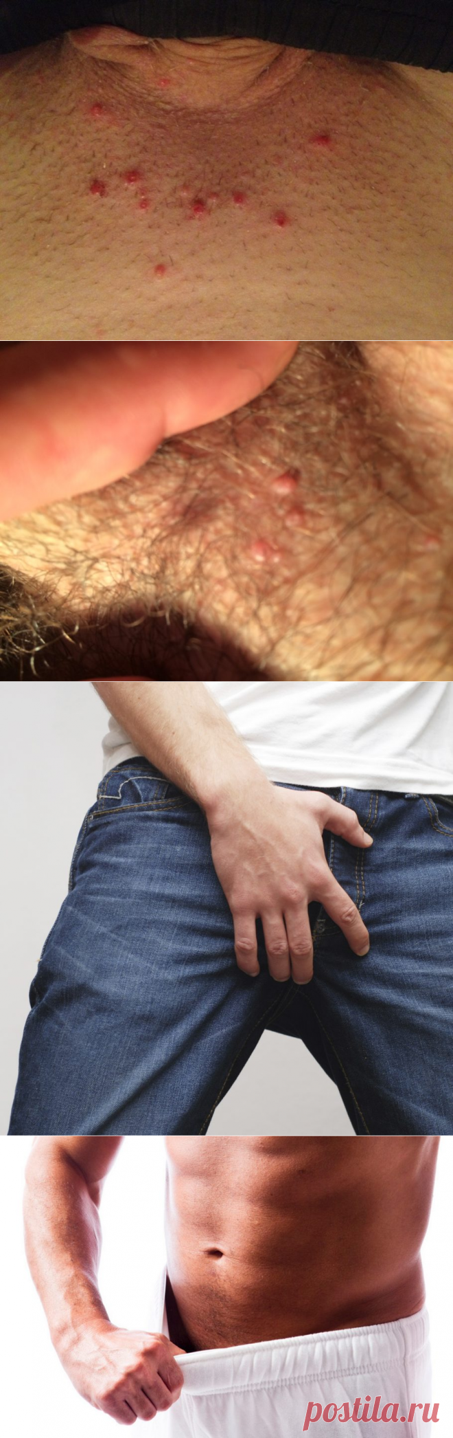 Прыщи на члене — почему появляются? [#лечение] Как избавится?