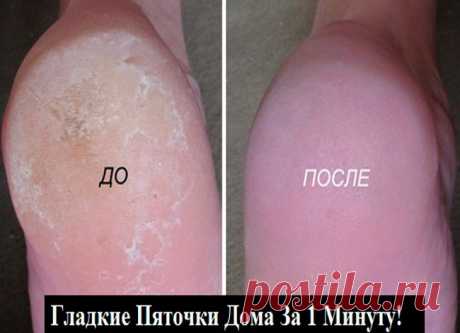 Супер-средство для ваших пяточек! Помогает за минуту! Итак….. Берём небольшую мисочку (такого размера, чтобы только поместились в неё ноги),...