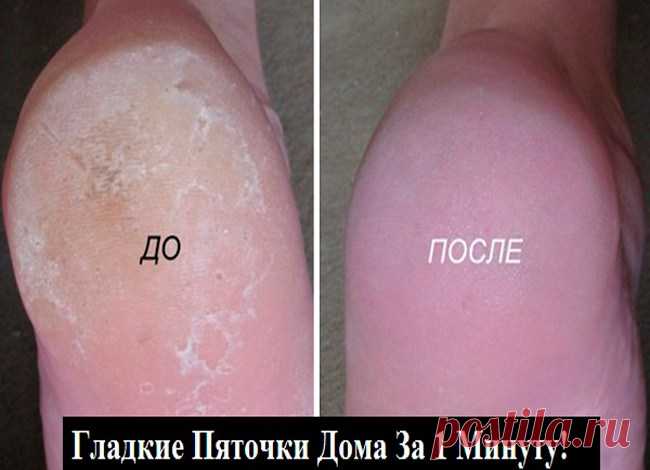 Супер-средство для ваших пяточек! Помогает за минуту! Итак….. Берём небольшую мисочку (такого размера, чтобы только поместились в неё ноги),...