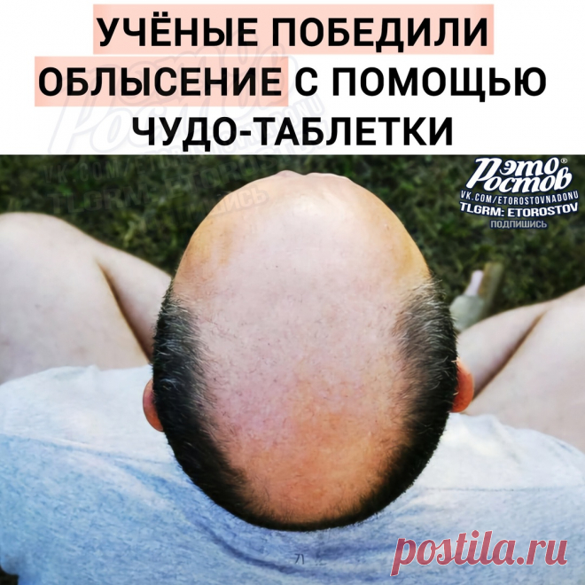 🦲 Облысение — В С Ё: учёным удалось победить.. | Это Ростов! Новости | ВКонтакте