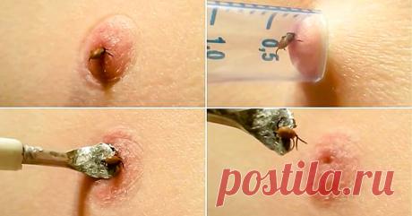 Чтобы вытащить клеща из ноги, он использовал лишь один предмет! Посмотрел это видео и научился. На всякий случай...