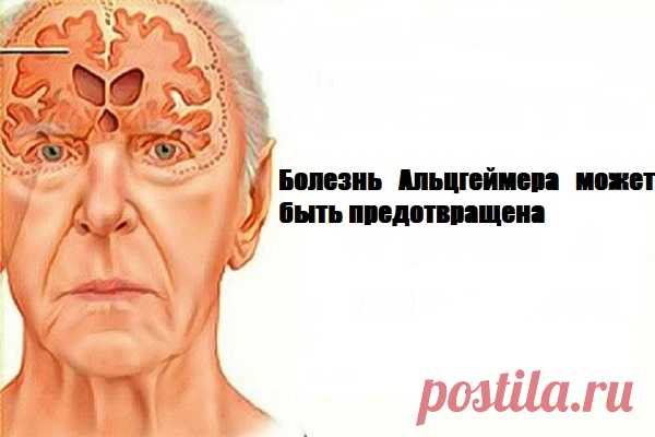 Болезнь Альцгеймера может быть предотвращена: только одно упражнение в день и ваша память станет намного лучше 


Практический метод профилактики болезни Альцгеймера







 


Альцгеймер является одним из самых распространенных дегенеративных заболеваний во всем мире, как правило, затрагивает очень старых люд…