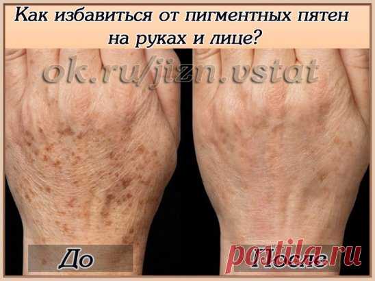 Как избавиться от пигментных пятен на руках и лице?
 tovarkishop.com/cYpu
Популярное мнение, что избавиться от веснушек и других пигментных пятен невозможно — прочно засело в головах современных людей. И хотя это утверждение устарело еще в начале 2000-х годов, большинство до сих пор верит, что для очищения кожи не существует способов.
Но исследования в области очищения кожи от погментации не стоя