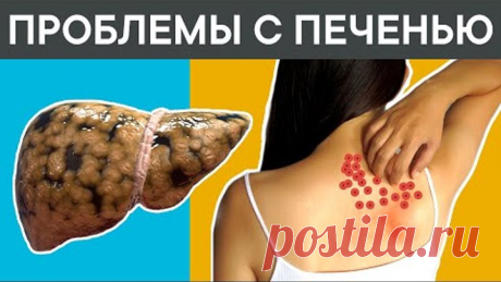 12 признаков того, что у вас СЕРЬЕЗНЫЕ ПРОБЛЕМЫ с ПЕЧЕНЬЮ. + 5 ЛУЧШИХ ПРОДУКТА для печени