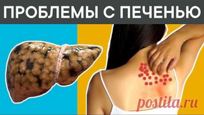 12 признаков того, что у вас СЕРЬЕЗНЫЕ ПРОБЛЕМЫ с ПЕЧЕНЬЮ. + 5 ЛУЧШИХ ПРОДУКТА для печени