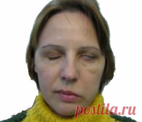 Цель ЛФК при неврите лицевого нерва: улучшить кровообращение в области шеи и головы, расслабить мышцы на здоровой стороне и стимулировать мышцы на больной стороне. Комплекс упражнений при неврите лицевого нерва делится на три части..
