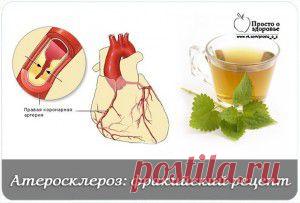 Атеросклероз и стенокардия. Фракийский рецепт = Следует нарвать  лесу верхушки крапивных кустиков. Их потребуется 500 г  обширный пакет. 
 
Листья только рвать, надев на руку перчатку или полиэтиленовый пакет. Дома листики хорошо размять деревянной лопаткой, но не резать ножом. 
 
Эти размятые листья залить литром 60-гр-ой водки, и в темной банке настаивать один день на свету, затем 8 дней в темном шкафу. Затем настой процедить и отжать. Принимать по 1 ч. л. за полчаса до еды 3-4 раза в день