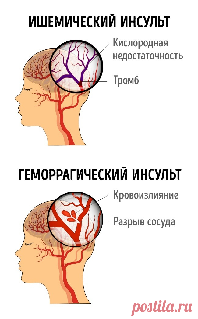 7 симптомов, которые помогут распознать инсульт у женщин