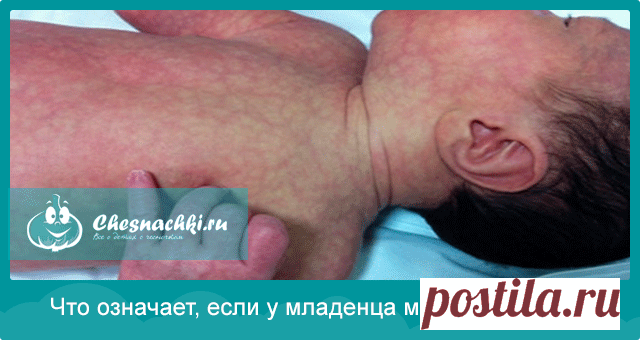 Мраморная кожа у младенца: что это и в чем причина?