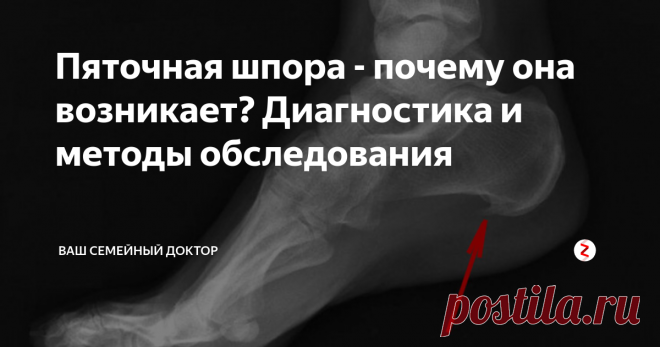 Пяточная шпора - почему она возникает? Диагностика и методы обследования Сегодня хочу коснуться такой насущной проблемы, как причины появления пяточной шпоры, а также поговорить о диагностике и симптомах этого заболевания, доставляющего огромный дискомфорт.
Что такое пяточная шпора? Это банальный костный нарост на пятке. Легкомысленное отношение к пяточной шпоре зачастую приводит к утрате трудоспособности на довольно протяжительный срок