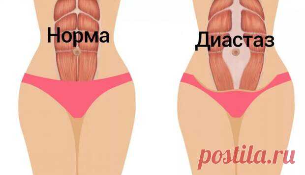Кому обычные тренировки для достижения плоского животика не помогают, следует делать упражнения при диастазе. Именно этот дефект является распространенной причиной неэффективности выполнения классических упражнений на пресс. Так же он порождает массу иных неприятностей, которые будут описаны чуть