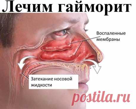 Лечим за копейки гайморит и не только!
В это сложно поверить! Так и не попробовала бы его если бы здоровье не подвело и мама под руку не поставила. 
Вообще Меновазин ассоциировался у меня с чем-то древним и бесполезным и я никогда бы не поверила что он может творить чудеса, если бы сама не столкнулась с ним.
Я даже не обратила внимание на восторги моей мамы. Она растирала суставы Меновазином и боль прошла, хотя до этого использовала дорогие мази которые давали кратковремен...