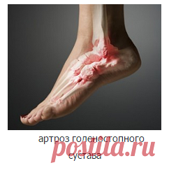 Лечение артроза голеностопного сустава
