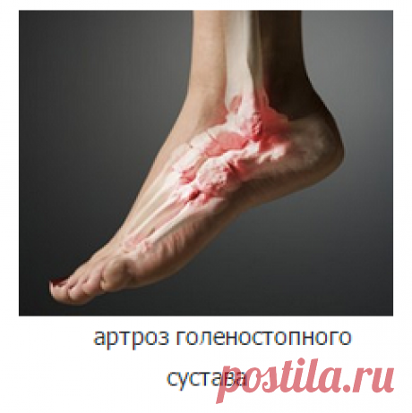 13 способов народного лечения артроза коленного сустава   Лечение артроза коленного сустава народными способами с помощью пиявок очень... Лечить болезнь в домашних условиях можно с помощью компрессов из.... 13 народных средств для лечения артроза коленного сустава – Как дополнительные методы врачевания все больше набирают популярности нетрадиционные методики, которые сочетают опыт восточных врачевателей и современные технологии. Черный воск для лечения суставов