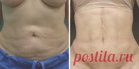 Домашнее средство избавит вас от жира на животе за 7 процедур + похудение до -4 кг. | Подслушано у диетолога | Яндекс Дзен